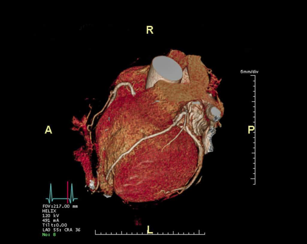 What Can A Pet Scan Of The Heart Show